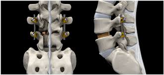 Lumbar Surgery 1