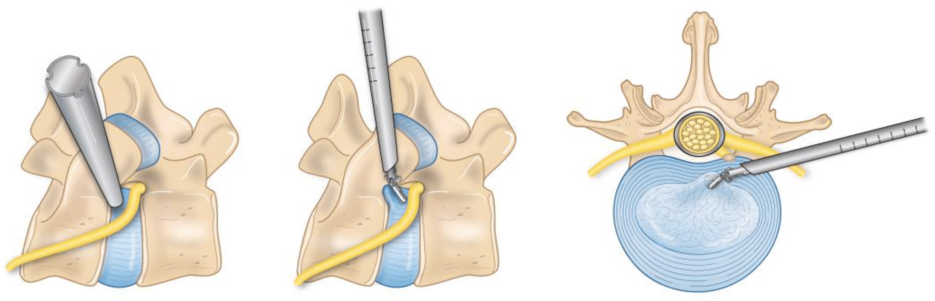 Lumbar Surgery 3