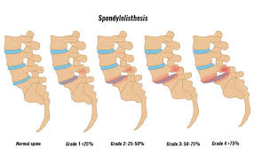 Traumatic Spine Surgery