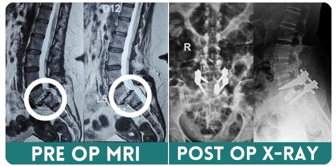 Traumatic Spine Surgery