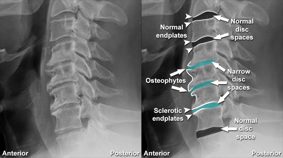 Compressive Myelopathy