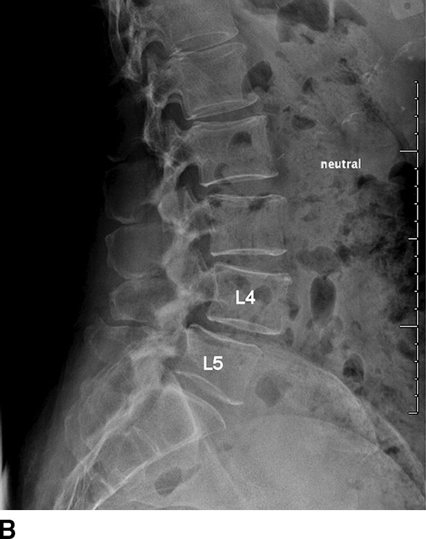 Compressive Myelopathy