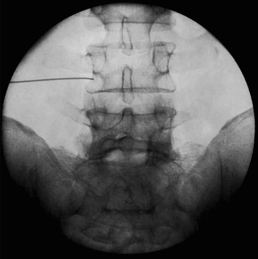 Transforaminal Nerve Root Block