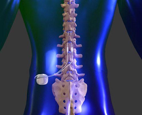 Spinal Cord Stimulation