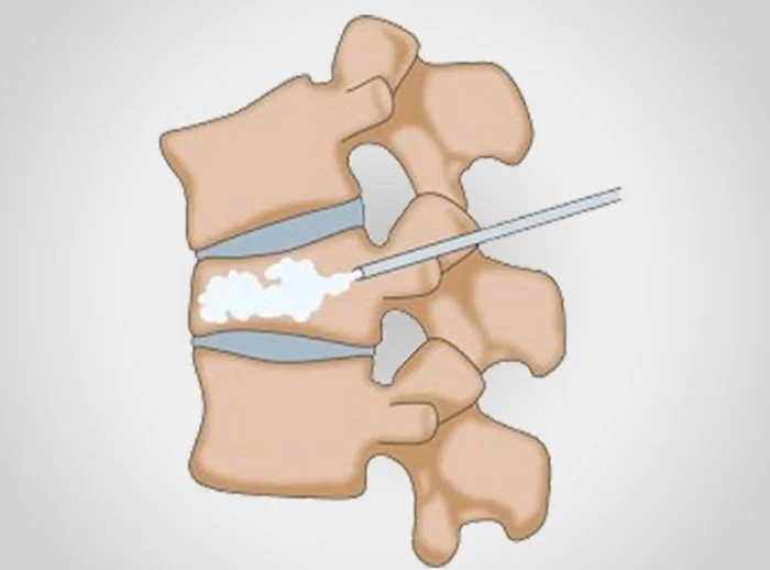 Vertebroplasty and Kyphoplasty