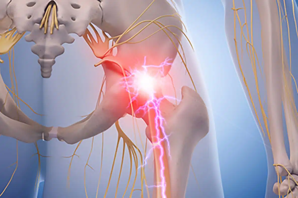 Sciatica/ Radiculopathy