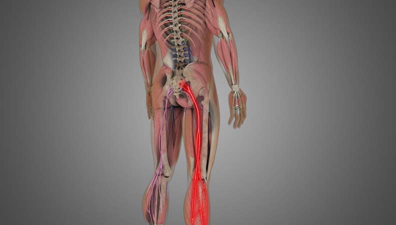 Sciatica/ Radiculopathy