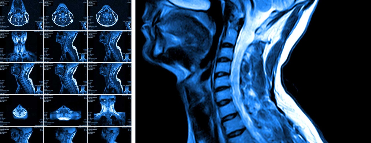 Compressive Myelopathy