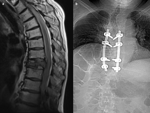 Compressive Myelopathy