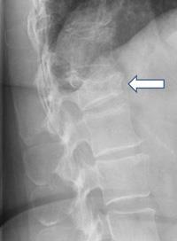 Osteoporotic Spine Fractures