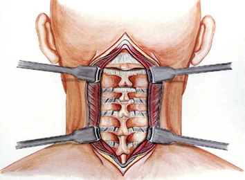 Cervical Surgery 1